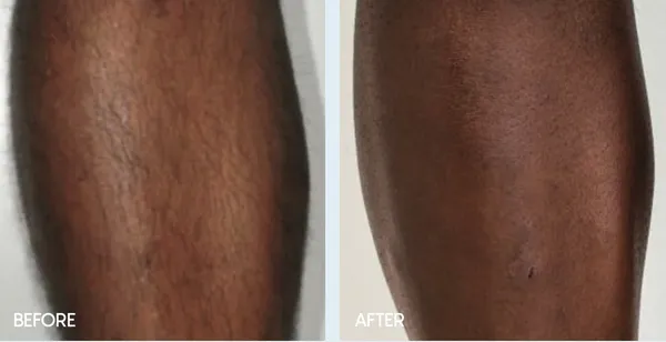 MOVEO HR HAIR REMOVAL